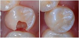White Fillings